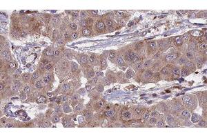 ABIN6276297 at 1/100 staining Human liver cancer tissue by IHC-P. (BVES Antikörper  (Internal Region))