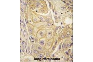 Formalin-fixed and paraffin-embedded human lung carcinoma tissue reacted with EphB2 antibody (ABIN391921 and ABIN2841731) , which was peroxidase-conjugated to the secondary antibody, followed by DAB staining. (EPH Receptor B2 Antikörper)