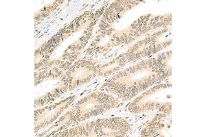 Immunohistochemistry analysis of paraffin-embedded human colon cancer using Isx (ABIN7074369) at dilution of 1: 2000