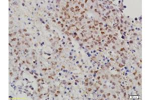 Formalin-fixed and paraffin embedded mouse cervical cancer labeled with Anti-MAT-1 Polyclonal Antibody, Unconjugated (ABIN686182) followed by conjugation to the secondary antibody and DAB staining (MTA1 Antikörper  (AA 601-715))