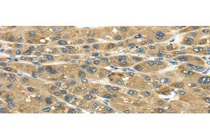 Immunohistochemistry of paraffin-embedded Human liver cancer tissue using UGT2B4 Polyclonal Antibody at dilution 1:45