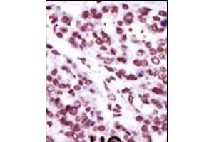 Formalin-fixed and paraffin-embedded human cancer tissue reacted with the primary antibody, which was peroxidase-conjugated to the secondary antibody, followed by AEC staining. (PKC epsilon Antikörper  (N-Term))