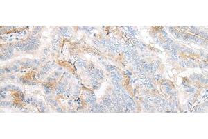 Immunohistochemistry of paraffin-embedded Human thyroid cancer tissue using TMEM248 Polyclonal Antibody at dilution of 1:25(x200)