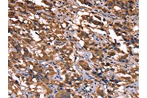 The image on the left is immunohistochemistry of paraffin-embedded Human thyroid cancer tissue using ABIN7190865(GREB1 Antibody) at dilution 1/40, on the right is treated with synthetic peptide. (GREB1 Antikörper)