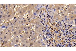 Detection of Bcl2L in Human Liver Cirrhosis Tissue using Polyclonal Antibody to B-Cell CLL/Lymphoma 2 Like Protein (Bcl2L) (BCL2L1 Antikörper  (AA 2-212))