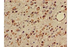 Immunohistochemistry of paraffin-embedded human glioma using ABIN7171919 at dilution of 1:100 (TTC27 Antikörper  (AA 590-817))