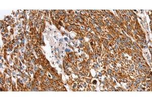 Immunohistochemistry of paraffin-embedded Human lung cancer using SSBP1 Polyclonal Antibody at dilution of 1:30 (SSBP1 Antikörper)
