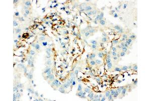 Anti-Transglutaminase 2 antibody, IHC(P) IHC(P): Human Lung Cancer Tissue (Transglutaminase 2 Antikörper  (C-Term))