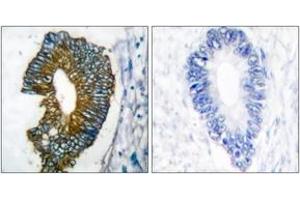 Immunohistochemistry analysis of paraffin-embedded human lung carcinoma tissue, using Keratin 18 Antibody. (Cytokeratin 18 Antikörper  (AA 381-430))