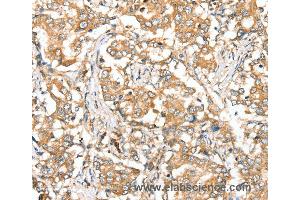 Immunohistochemistry of Human lung cancer using SIRT4 Polyclonal Antibody at dilution of 1:35
