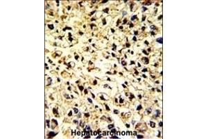 Formalin-fixed and paraffin-embedded human hepatocarcinoma with DCL-1 Antibody (Center), which was peroxidase-conjugated to the secondary antibody, followed by DAB staining. (DCL1 Antikörper  (AA 143-170))