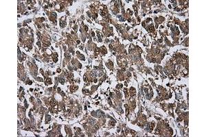 Immunohistochemical staining of paraffin-embedded Carcinoma of liver tissue using anti-BTK mouse monoclonal antibody. (BTK Antikörper)