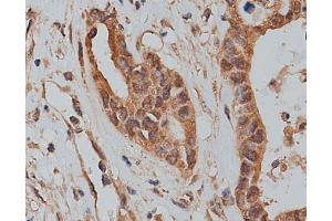 ABIN6273320 at 1/200 staining human colon cancer tissue sections by IHC-P.