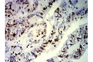 Immunohistochemical analysis of paraffin-embedded rectum cancer tissues using MKI67 mouse mAb with DAB staining. (Ki-67 Antikörper  (AA 1160-1493))