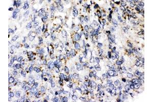 Perilipin 3 was detected in paraffin-embedded sections of human lung cancer tissues using rabbit anti- Perilipin 3 Antigen Affinity purified polyclonal antibody (Catalog # ) at 1 ?