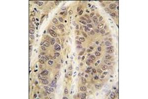 Formalin-fixed and paraffin-embedded human hepatocarcinoma tissue reacted with ADK antibody (C-term), which was peroxidase-conjugated to the secondary antibody, followed by DAB staining. (ADK Antikörper  (C-Term))