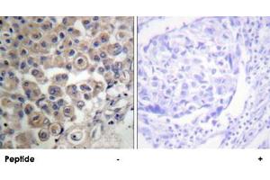 Immunohistochemistry analysis of paraffin-embedded human breast carcinoma tissue using PLCB3 polyclonal antibody . (PLCB3 Antikörper)