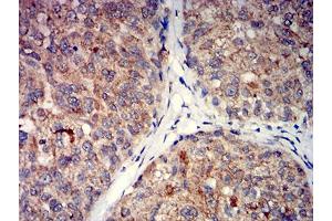 Immunohistochemical analysis of paraffin-embedded bladder cancer tissues using GRM5 mouse mAb with DAB staining.