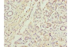Immunohistochemistry of paraffin-embedded human pancreatic cancer using ABIN7144074 at dilution of 1:100 (ANAPC5 Antikörper  (AA 2-232))