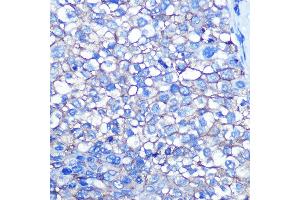 Immunohistochemistry of paraffin-embedded human liver cancer using CD13/ANPEP Rabbit mAb (ABIN7265525) at dilution of 1:100 (40x lens). (CD13 Antikörper)