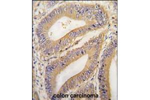 Formalin-fixed and paraffin-embedded human colon carcinoma tissue reacted with PHB2 Antibody , which was peroxidase-conjugated to the secondary antibody, followed by DAB staining. (Prohibitin 2 Antikörper  (N-Term))