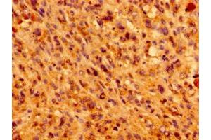 Immunohistochemistry of paraffin-embedded human melanoma using ABIN7156987 at dilution of 1:100 (IFT46 Antikörper  (AA 1-304))