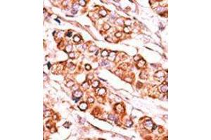 Formalin-fixed and paraffin-embedded human cancer tissue reacted with the primary antibody, which was peroxidase-conjugated to the secondary antibody, followed by DAB staining. (PDXK Antikörper  (C-Term))