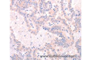 Immunohistochemistry of Human thyroid cancer using INA Polyclonal Antibody at dilution of 1:25 (INA Antikörper)