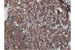 Immunohistochemical staining of paraffin-embedded Adenocarcinoma of Human breast tissue using anti-AKT1 mouse monoclonal antibody. (AKT1 Antikörper)