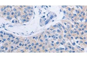 Immunohistochemistry of paraffin-embedded Human lung cancer tissue using HOXA6 Polyclonal Antibody at dilution 1:60 (HOXA6 Antikörper)