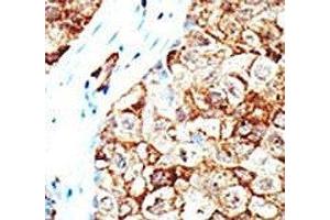 IHC analysis of FFPE human breast carcinoma tissue stained with the Ubiquilin1 antibody