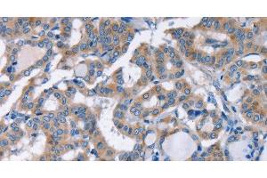 Immunohistochemistry of paraffin-embedded Human thyroid cancer using KCNQ5 Polyclonal Antibody at dilution of 1:30