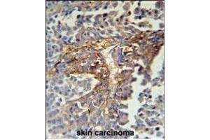 ARMC5 Antibody (C-term) (ABIN651593 and ABIN2840314) immunohistochemistry analysis in formalin fixed and paraffin embedded human skin carcinoma followed by peroxidase conjugation of the secondary antibody and DAB staining. (ARMC5 Antikörper  (C-Term))