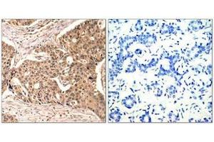Immunohistochemical analysis of paraffin-embedded human breast carcinoma tissue using Paxillin(Phospho-Tyr118) Antibody(left) or the same antibody preincubated with blocking peptide(right). (Paxillin Antikörper  (pTyr118))