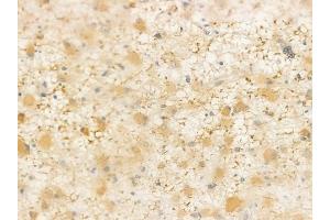ABIN6257831 and ABIN6274416 at 1/100 staining human astrocytoma by IHC-P. (AKAP14 Antikörper  (N-Term))