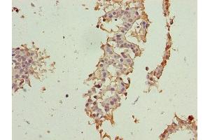 Immunohistochemistry of paraffin-embedded human breast cancer using ABIN7147338 at dilution of 1:100 (CRABP1 Antikörper  (AA 2-137))