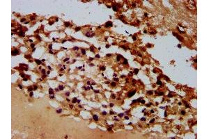 IHC image of ABIN7167931 diluted at 1:600 and staining in paraffin-embedded human melanoma performed on a Leica BondTM system. (ARHGAP15 Antikörper  (AA 1-154))