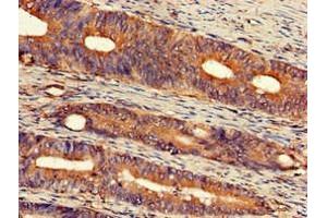 Immunohistochemistry of paraffin-embedded human colon cancer using ABIN7152309 at dilution of 1:100 (EXT2 Antikörper  (AA 180-267))