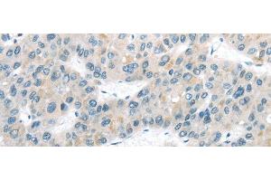 Immunohistochemistry of paraffin-embedded Human liver cancer tissue using VLDLR Polyclonal Antibody at dilution 1:40 (VLDLR Antikörper)