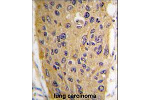 Formalin-fixed and paraffin-embedded human lung carcinoma tissue reacted with WIF1 polyclonal antibody  , which was peroxidase-conjugated to the secondary antibody, followed by DAB staining. (WIF1 Antikörper  (AA 350-379))