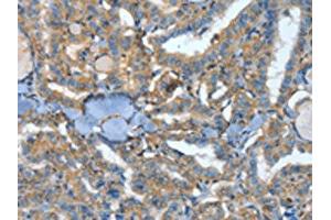 The image on the left is immunohistochemistry of paraffin-embedded Human thyroid cancer tissue using ABIN7128589(ATP4B Antibody) at dilution 1/40, on the right is treated with fusion protein. (ATP4b Antikörper)
