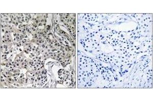 Immunohistochemistry analysis of paraffin-embedded human breast carcinoma tissue, using USP19 Antibody.
