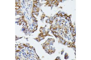 Immunohistochemistry of paraffin-embedded human lung cancer using MTIF2 antibody (ABIN7268591) at dilution of 1:100 (40x lens).