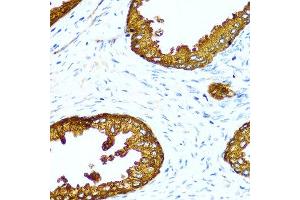 Immunohistochemistry of paraffin-embedded human prostate using ACPP antibody at dilution of 1:100 (40x lens). (ACPP Antikörper)