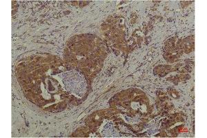 Immunohistochemistry (IHC) analysis of paraffin-embedded Human Breast Carcinoma using P44/42 MAPK (ERK1/2) Mouse Monoclonal Antibody diluted at 1:200. (ERK1/2 Antikörper)