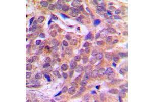 Immunohistochemical analysis of Beta-catenin (pS37) staining in human breast cancer formalin fixed paraffin embedded tissue section. (beta Catenin Antikörper  (N-Term, pSer37))