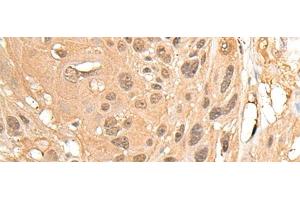 Immunohistochemistry of paraffin-embedded Human ovarian cancer tissue using MED23 Polyclonal Antibody at dilution of 1:30(x200) (MED23 Antikörper)