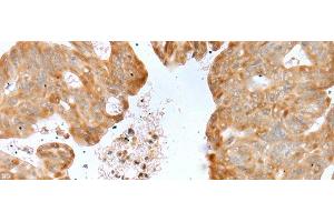 Immunohistochemistry of paraffin-embedded Human gastric cancer tissue using P2RY4 Polyclonal Antibody at dilution of 1:40(x200) (P2RY4 Antikörper)