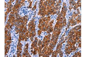 The image on the left is immunohistochemistry of paraffin-embedded Human gastic cancer tissue using ABIN7130460(NR4A2 Antibody) at dilution 1/20, on the right is treated with fusion protein. (NR4A2 Antikörper)