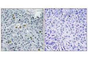 Immunohistochemistry analysis of paraffin-embedded human breast carcinoma tissue using TOP2A (Phospho-Ser1106) antibody. (Topoisomerase II alpha Antikörper  (pSer1106))